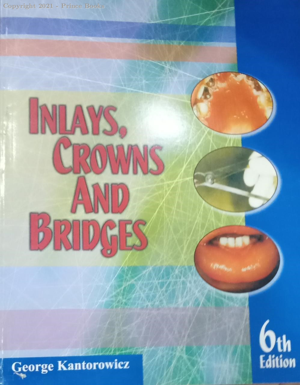 inlays crown and bridgs