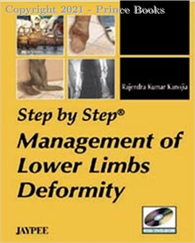 Management of Lower Limbs Deformity