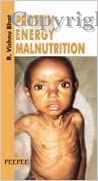 Protein Energy Malnutrition, 1E