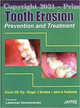 Tooth Erosion Prevention and Treatment, 1e