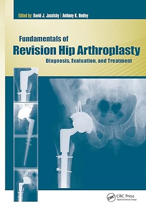 71844153 - Fundamentals of Revision Hip Arthroplasty: Diagnosis ...