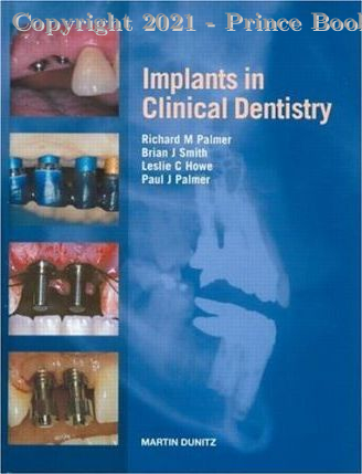 implants in clinical dentistry, 1e